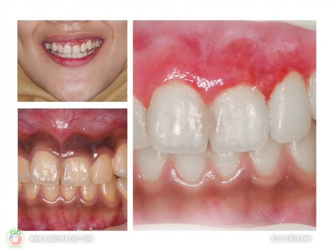 gio-gum-rejuvenation